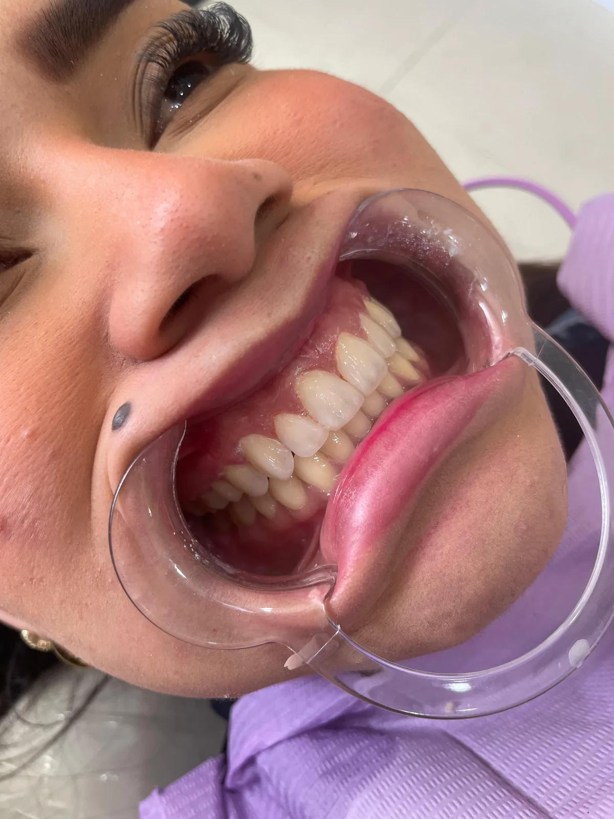 Resultado real de diseño de sonrisa en Nova Sonrisa