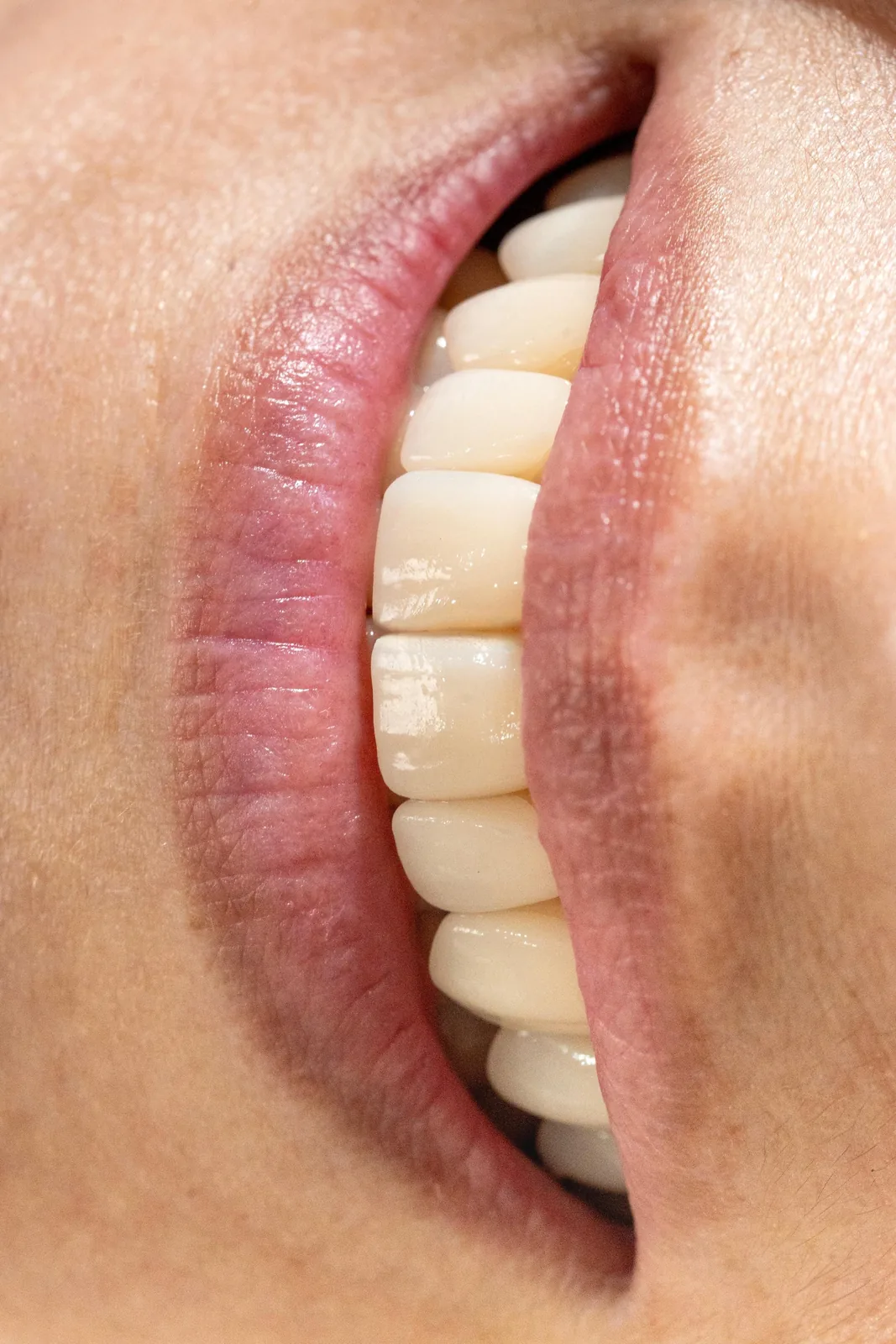 Resultado real de carillas dentales en Nova Sonrisa